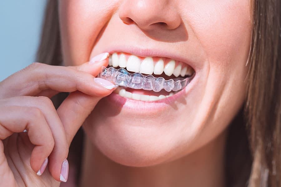 Clear Aligners (Invisible Braces)
