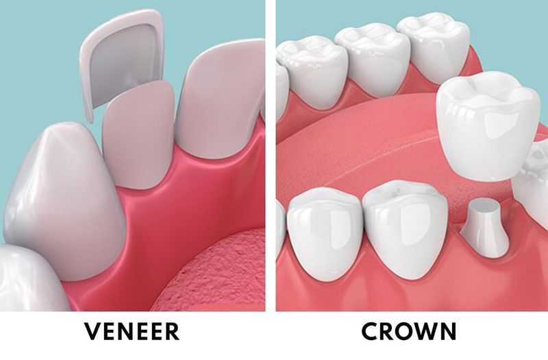 Dental Crowns & Veneers
