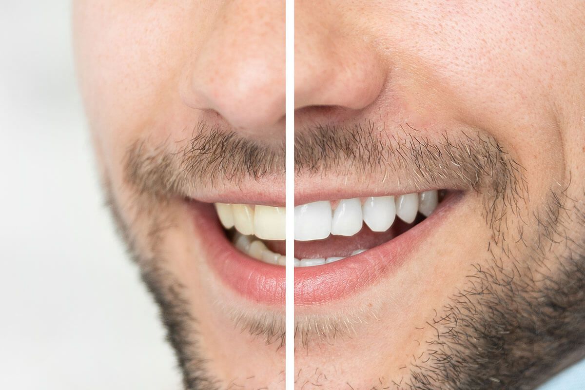 Teeth Whitening (Bleaching)