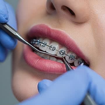 Braces (Fixed Orthodontic Treatment)